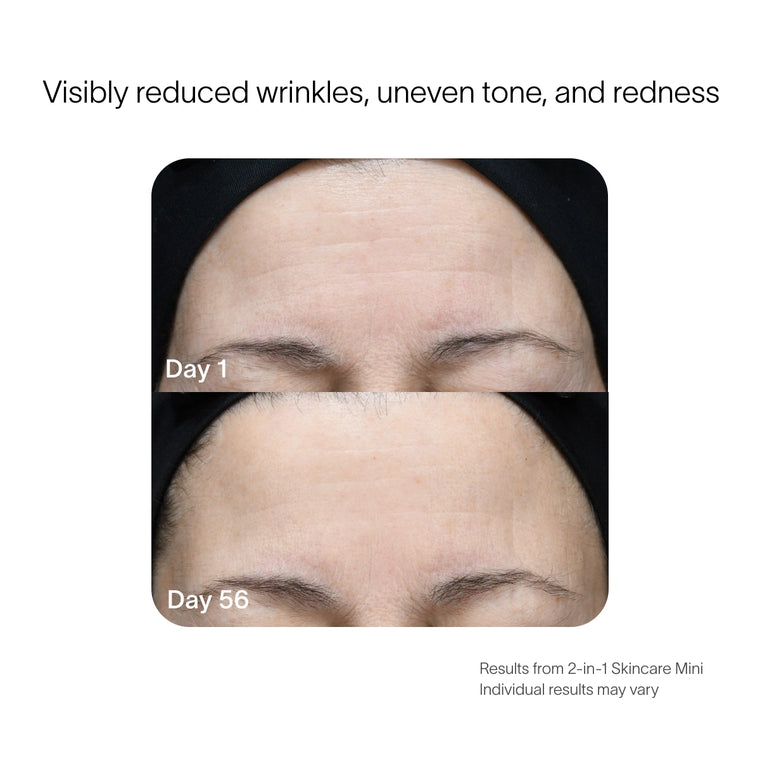 Before and after, forehead