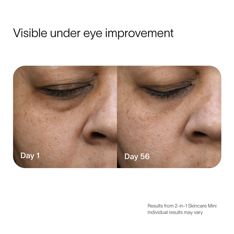 Before and after, under-eye area