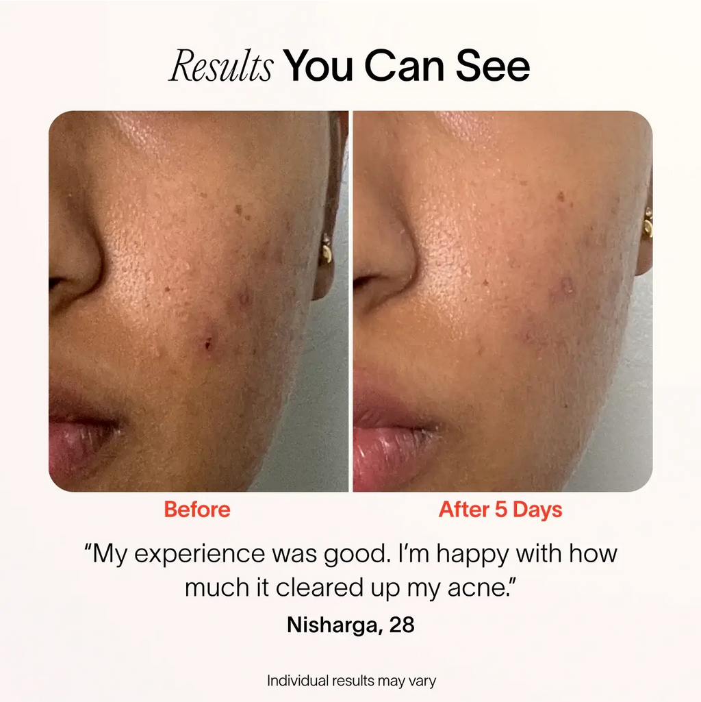 Before and after, blemish-prone skin