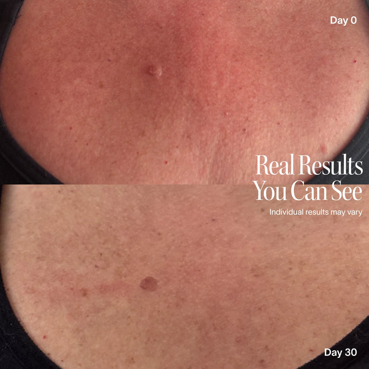 Before and after, neck and chest
